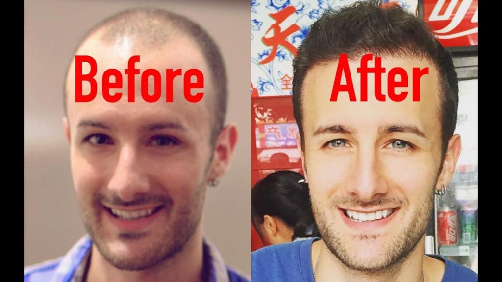 Hair replacement systems for men with alopecia » Dailygram ... The Business Network