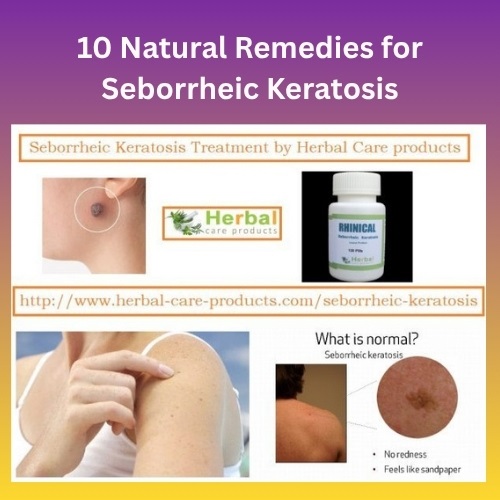 10 Natural Remedies for Seborrheic Keratosis - Herbal Care Products - Blog