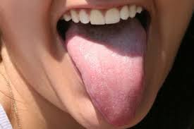 Burning Mouth Syndrome Home Remedies, Causes, Natural Herbs Clinic
